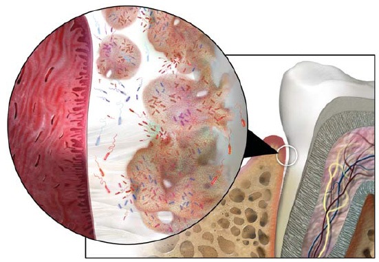 periodontitis_bacterias