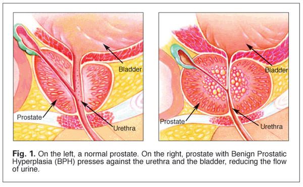 Fig. 1. Benign Postatic Hyperplasia