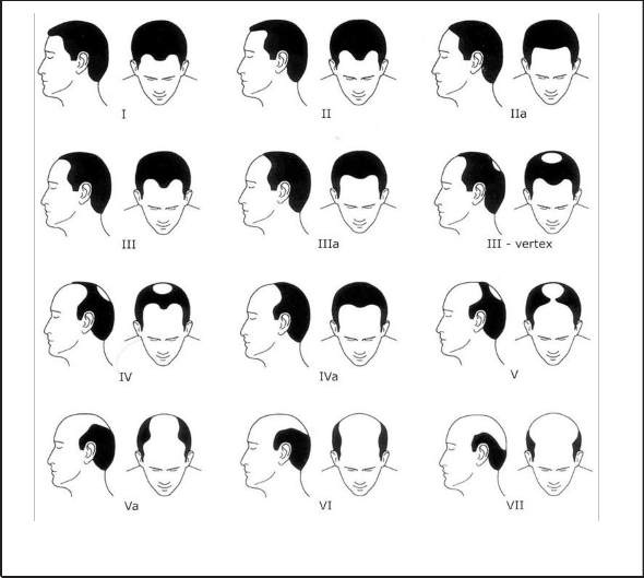 Hair Loss Chart Norwood