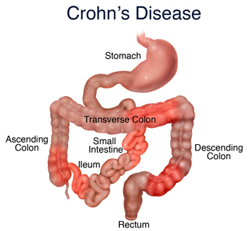 crohns_disease
