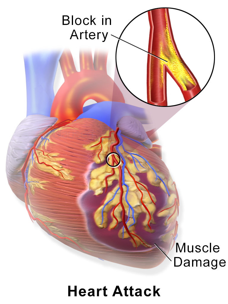 Myocardial-Infarction-Heart-Disease