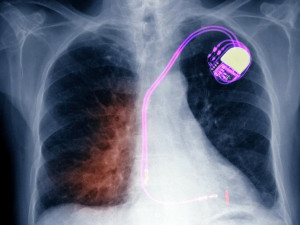 Researchers Create Biological Pacemaker by Reprogramming Heart Cells ...