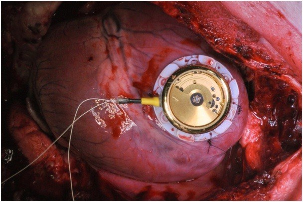 Batteryless pacemaker