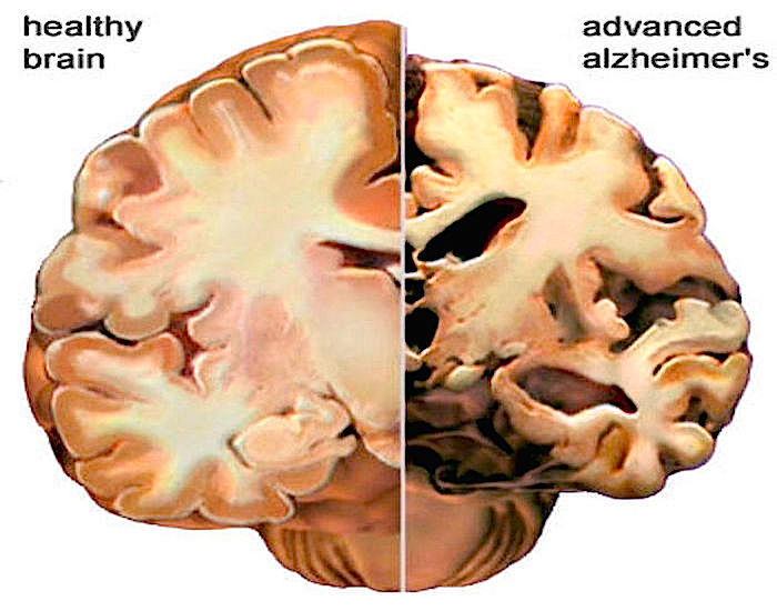 alzheimer-brain