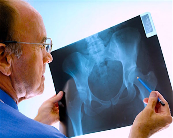 Hip Fractures Most Of The Elderly Unlikely To Fully Recover