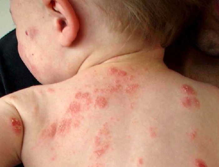 treatment-eczema-children